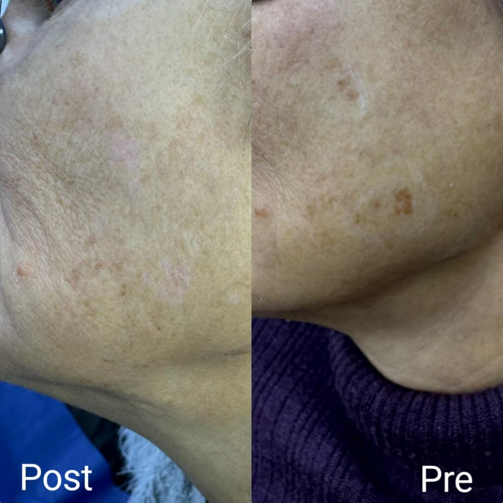 Facial pigmentation removal in Hurghada